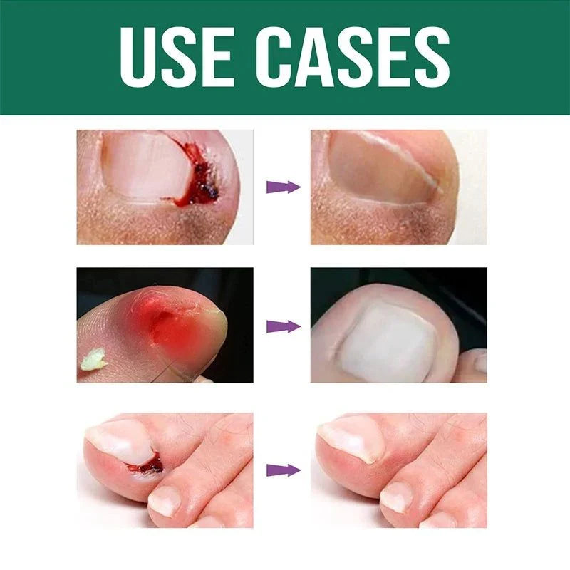 Anti Paronychia Relief Oil- Buy 1 get 1